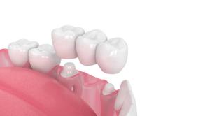 Quality porcelain bridge Strong non-irritating Comfortable Strong Wear Resistance wholesale