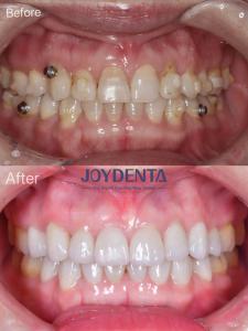 Quality Porcelain Veneer Oral Restoration wholesale