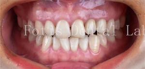 Quality Cosmetic Dentistry Dental Porcelain Veneers With High Stain Resistance wholesale