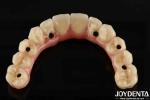 Comfortable Wear Titanium Malong Hybrid Bridge Dental Adjustable Design Light