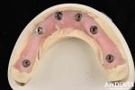 Durable Dental Aesthetic Titanium Malong Hybrid Bridge For Care