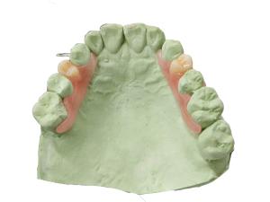Quality Safe and Comfortable Plant Reproduction Resin Customized Fit for Sensitive Patients wholesale