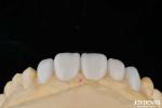Customization Porcelain Material Emax Teeth Veneers For High Aesthetics Bonding