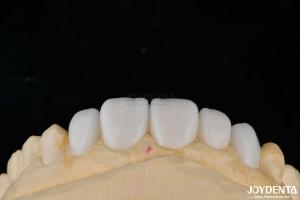 Quality Customization Porcelain Material Emax Teeth Veneers For High Aesthetics Bonding wholesale