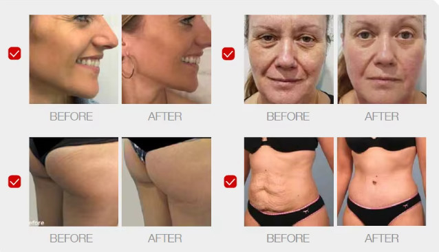 Professional 7D Hifu Eyes Wrinkles Removal Body Shaping Face Lifting MMFU Machine