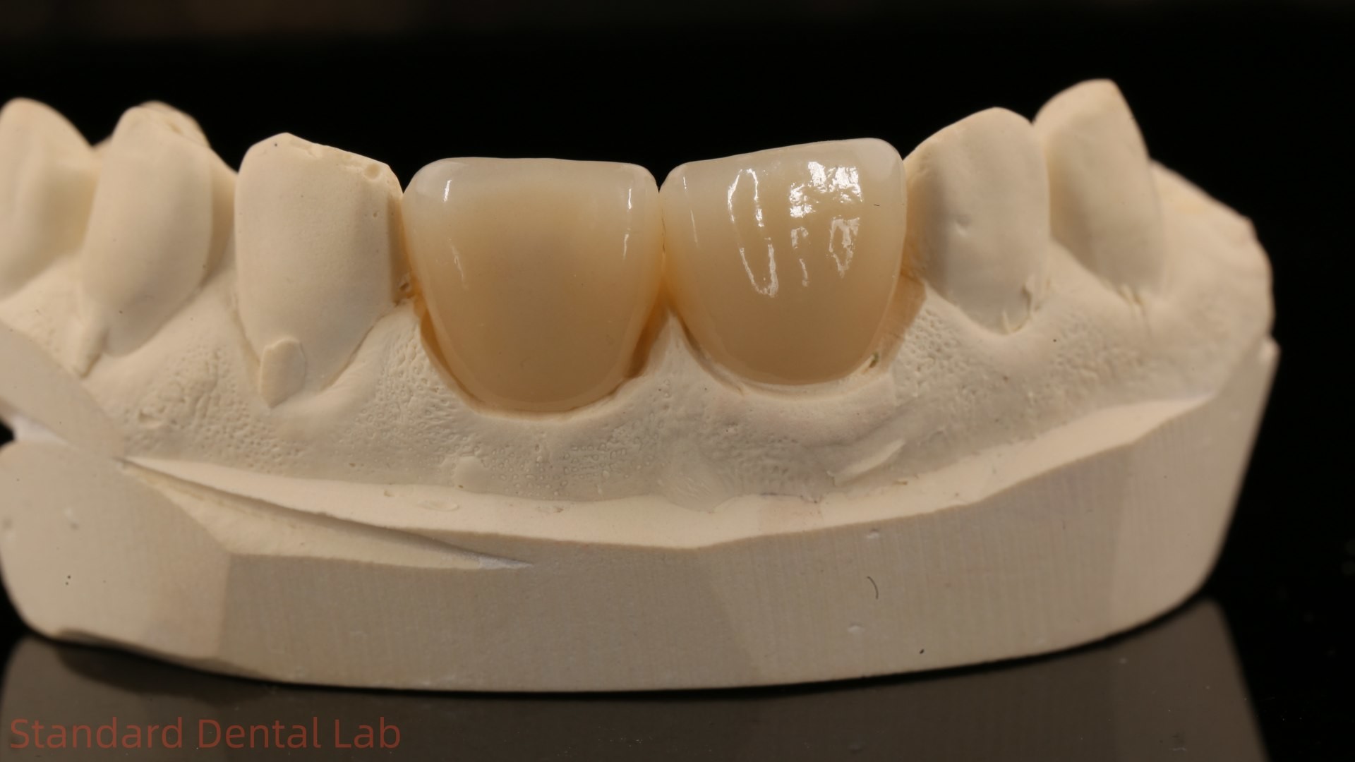 Full Contour Zirconia Crown and High Aesthetic Natural Dental Bridge 5 Year Guarantee