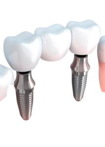 Quality Realistic Appearance Bridges And Dental Crowns Strong Stability Natural Color wholesale