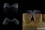 Ceramic For Natural Aesthetics Dental Veneers Stain Resistance Maintains