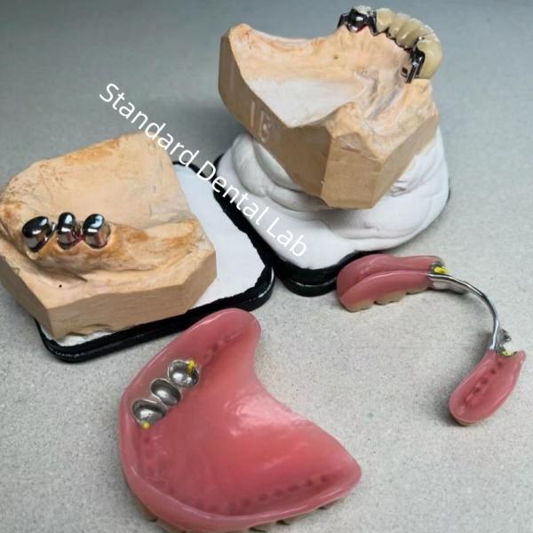 Cheap High Esthetics CAD CAM Tooth Partial Denture Attachment Replacement Standard Dental Lab for sale