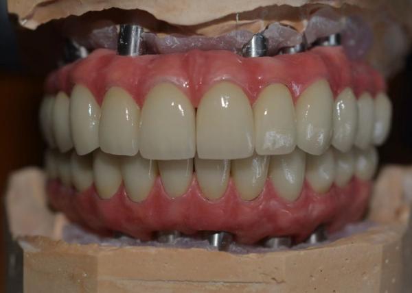 Prioritizing Patient Satisfaction Our Commitment To Quality Dental Implant