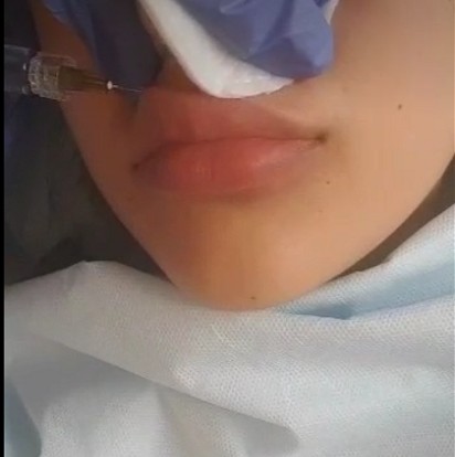 Clinic Injectable Dermal Filler , Transparent Hyaluronic Acid Injection