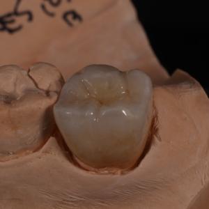 Quality Full Contour Translucent Zirconia Crown for Aesthetically Pleasing Results wholesale