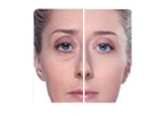 Picosecond Laser Tattoo Removal Equipment , Nd Yag Laser Equipment High Energy