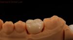 Dental Digital Full Zirconia Crown with Noritake Porcelain 3D Print Model 5 Year