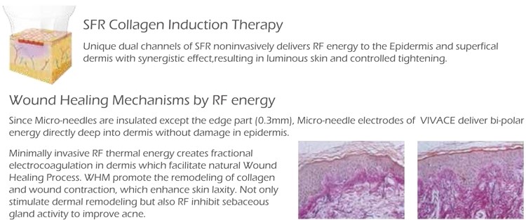 NUBWAY 0.3-3mm needle Fractional RF microneedle radio frequency micro needling for wrinkles machine
