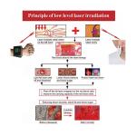FDA Portable Laser Watch For High Blood Pressure ，Medical Physical Therapy