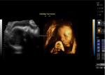 Portable Doppler Ultrasound Machine Portable Ultrasound Scanner 3D 4D Probe