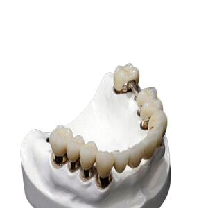 Quality CO CR MK1 Precision Attachment Denture Corrosion Resistance wholesale