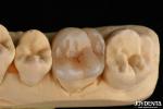 Natural Looking Emax Inlay Onlay Long Lasting Dental Restoration 0.5mm 1mm 1.5mm