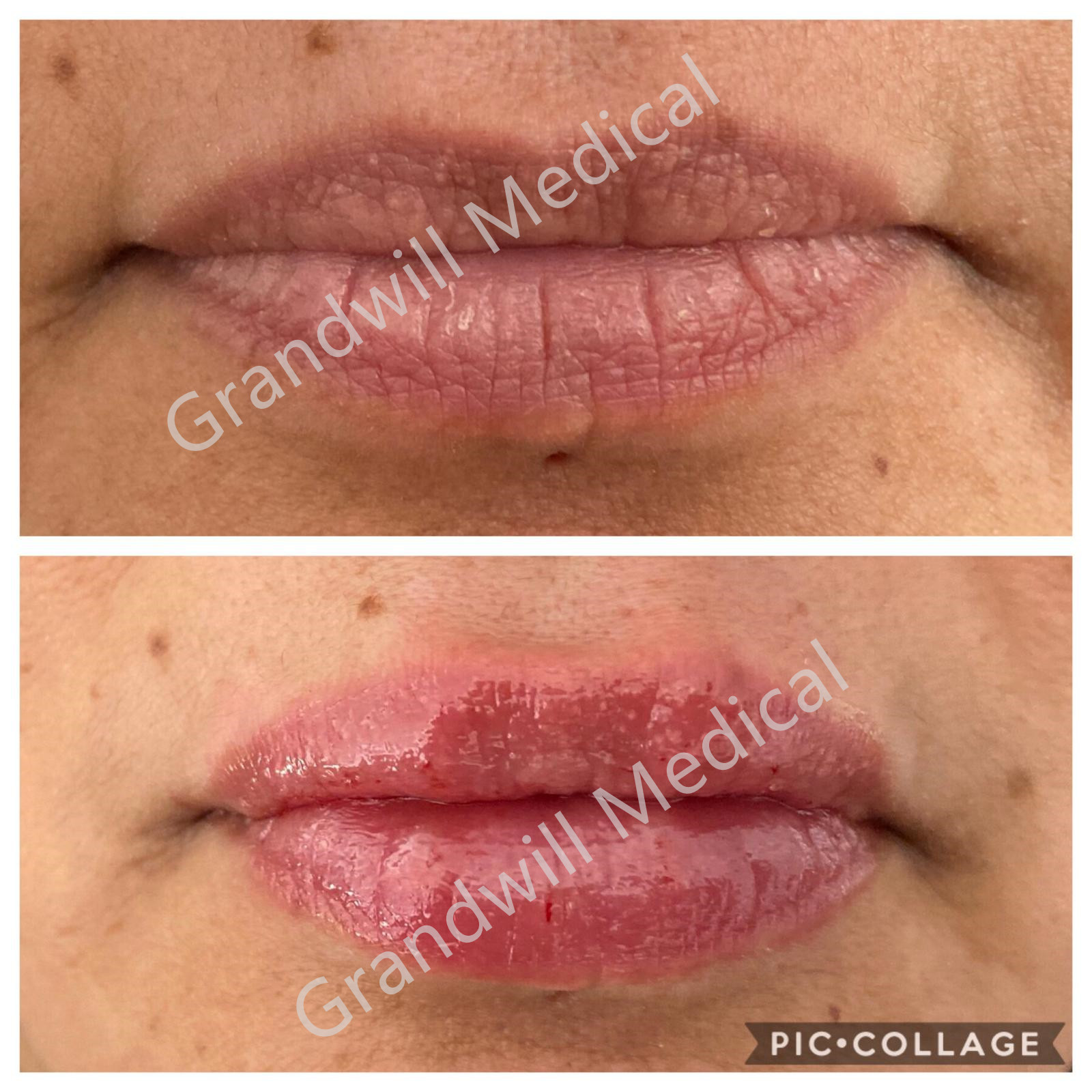 Non Surgical Lip Enhancement Fillers Hyaluronic Acid Lip Injections