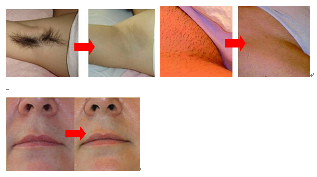 Vertical 808nm Diode Laser Hair Removal Equipment With 10 - 1500 Ms Pulse Duration