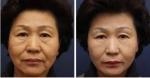Best Sell Forimi Medical Aesthetic Professional Korea Focused Ultrasound Hifu