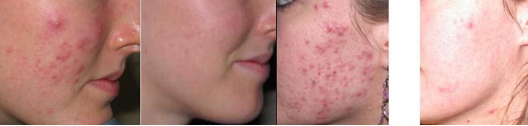 IPL Beauty Machine Pigment Removal Skin Rejuvenation Beauty Salon Upper Lip