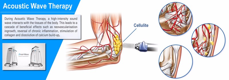 acoustic wave therapy magnetic wave therapy ultrasonic slimming equipment