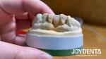 Customizable Dental Maryland Resin Bonded Bridges for Anterior And Premolar