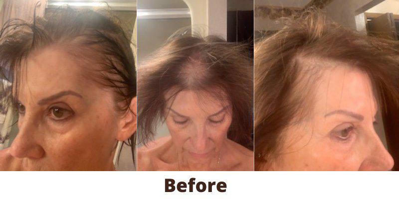 OEM ODM Alopecia Areata Laser Hair Growth Caps For Hair Rejuvenation