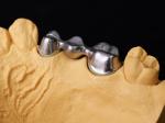 Audental 43 Silver-palladium Porcelain Alloy White Pd43% Noble Alloy For Strong
