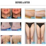 Cryo+Laser+40k Cavitation for Body Face 360 Surrounding Cooling Technology