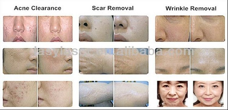 Stationary Fractional Laser Co2 Machine Scar Removal Infrared Skin