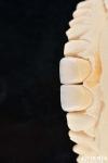 Long Lasting Dental Feldspathic Veneer Natural Tooth Color Translucent