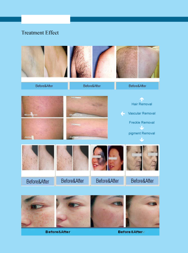 Commercial Multifunctional Beauty Machine 755nm 808nm 1064nm For IPL Opt Laser Hair Removal