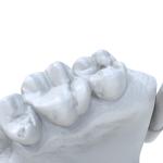 Precision Dental Model Resin Ultra Tough Dental Resin 3d Printing
