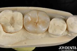 Quality Adhesive Cementation Zirconia Dental Inlays And Onlays Natural Looking wholesale