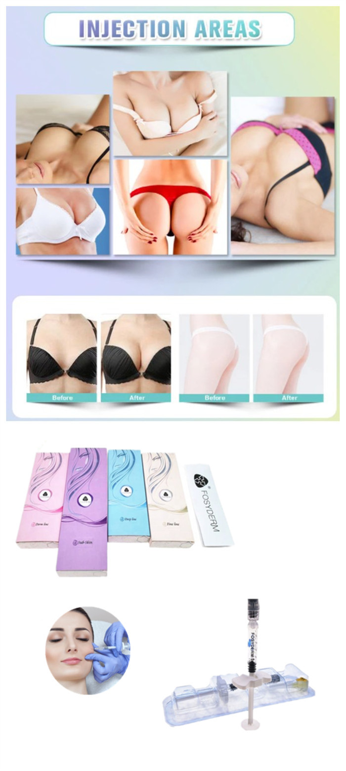 Cross Linked Sodium Hyaluronate Injectable Dermal Filler