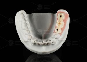 Quality Screw Retained Titanium Custom Abutment Porcelain Fused To Zirconia wholesale
