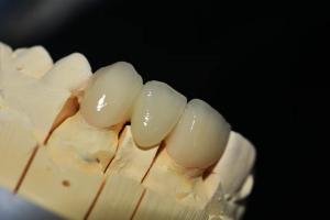 Quality Customized Zirconia Denture Dental lab - Fast Delivery and Repair wholesale