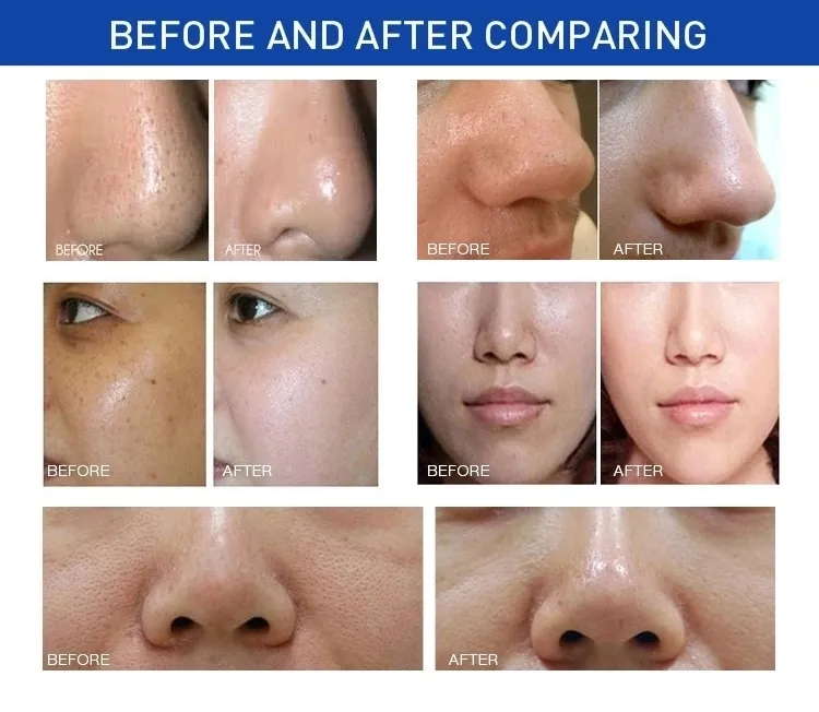 Hydrabeauty 9 in 1 Supper Vacuum Power RF Bio Lifting SPA Facial Machine/Hydro Aqua Oxygen Facial Machine