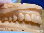 Lightweight and Smooth Dental Veneers Stain Resistance Long-lasting Durability