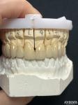 Seamless PFM Porcelain Fused Metal Crown For Long Term Biocompatible Restoration