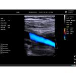 Color Doppler Portable Ultrasound Machine Medical USG PW CW DICOM Cardiac Probe