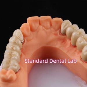 Quality Digital Non Precious Metal Porcelain Crown PFM Bridge Dental wholesale