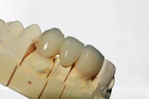 Quality Beautiful Dental Crown Bridge Wear Natural Restore Chewing Power wholesale
