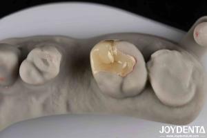 Quality Strong Resistance To Fracture Emax Inlay Onlay Natural-looking Esthetics And Durability wholesale