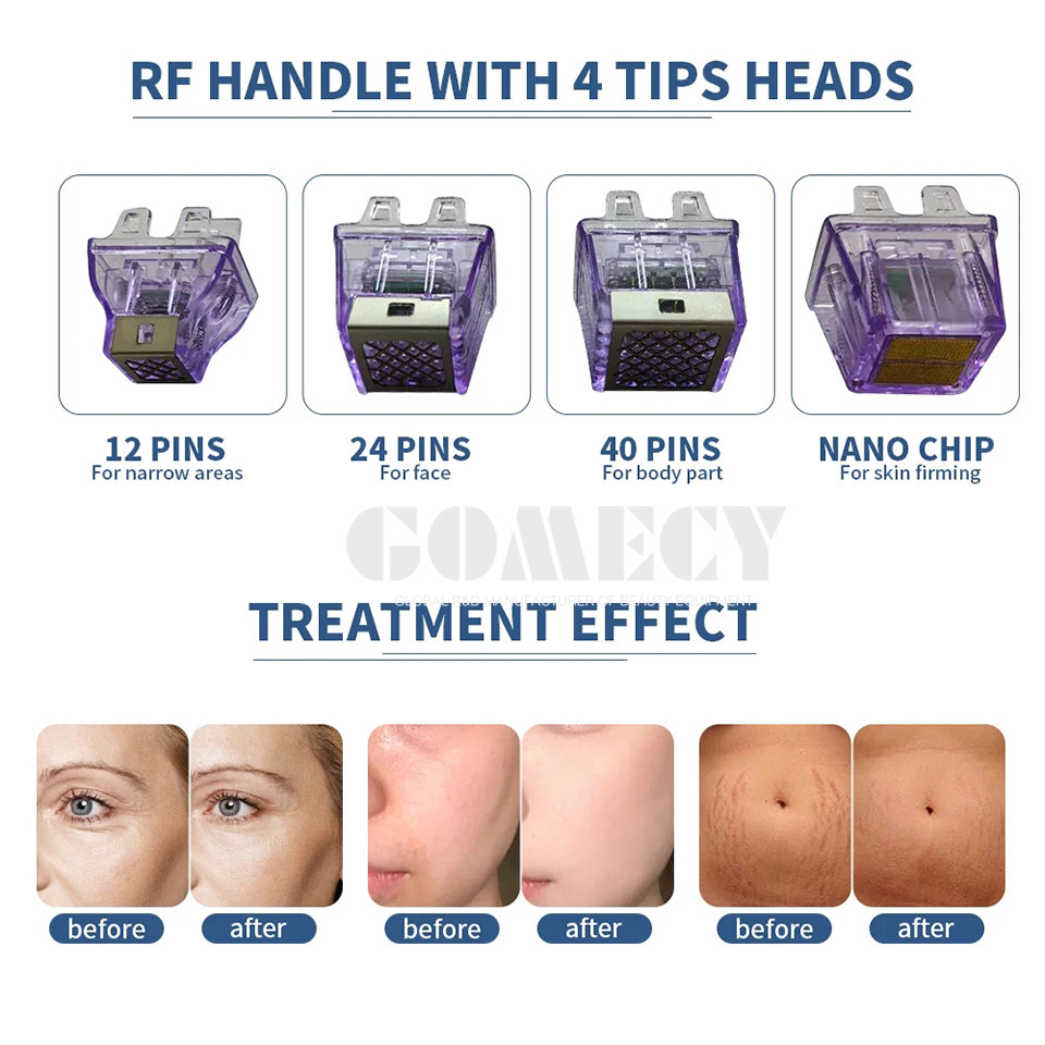 2024 Morpheus8 Radio Frequency Micro Needling Machine With Ice Hammer For Your Skin Scar Acne Scar Stretch Marks
