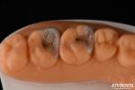 Custom Compound Inlay Onlay For Minimally Invasive Dental Restoration