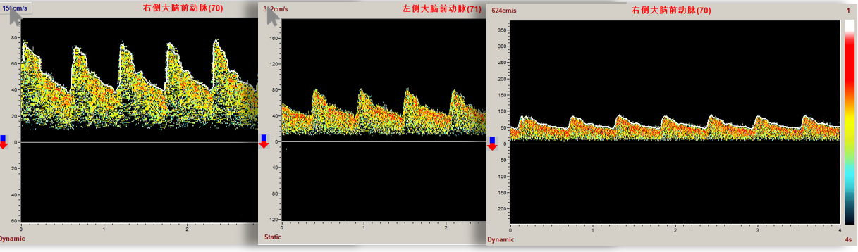 Four-depth Ultrasound Transcranial Doppler blood vessels analysis TCD system